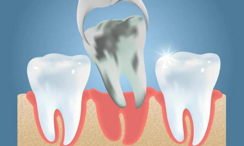 5 Warning Signs You Need to Get Wisdom Teeth Removed